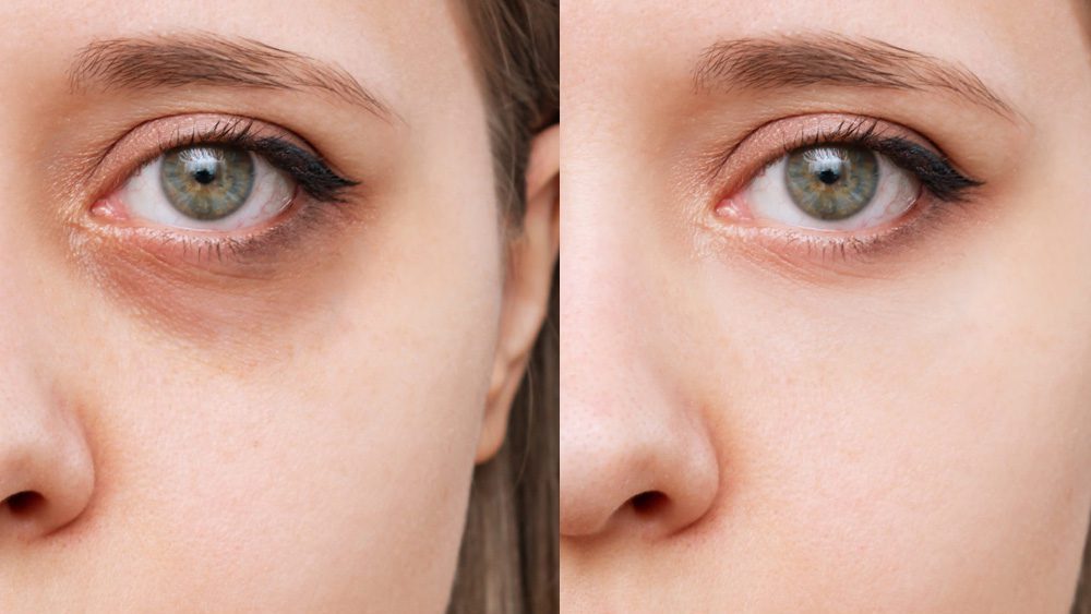 Treating dimples and darkness under the eyes