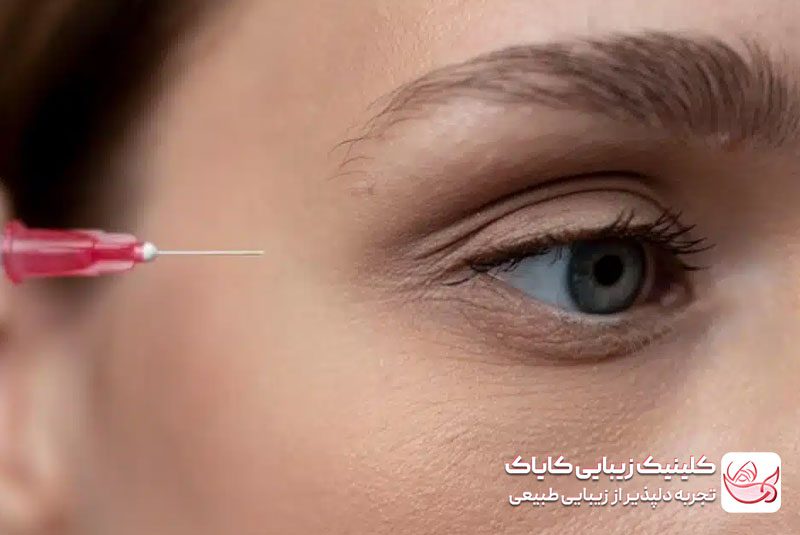 درمان گودی زیر چشم با تزریق prp