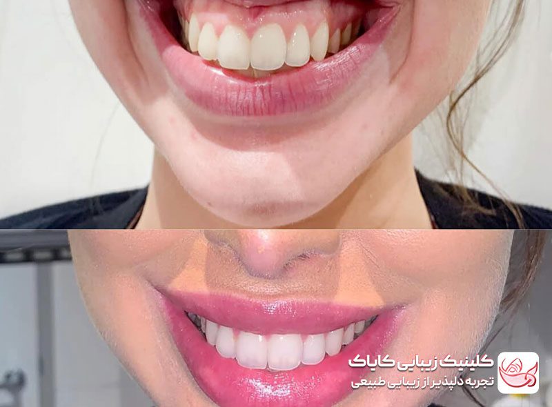 بوتاکس لبخند لثهای قبل و بعد