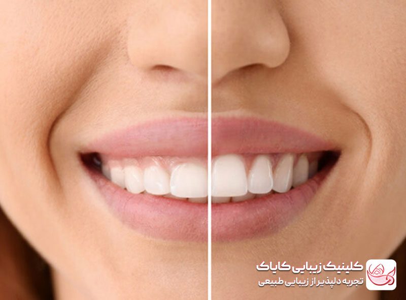 بوتاکس لبخند لثه ای قبل و بعد
