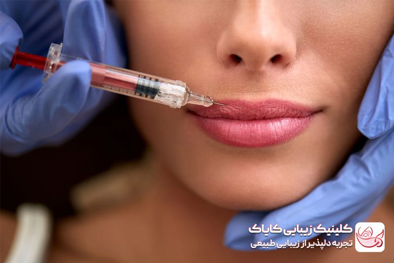 تزریق چربی به لب برای فرم دهی لب ها - فیلر لب
