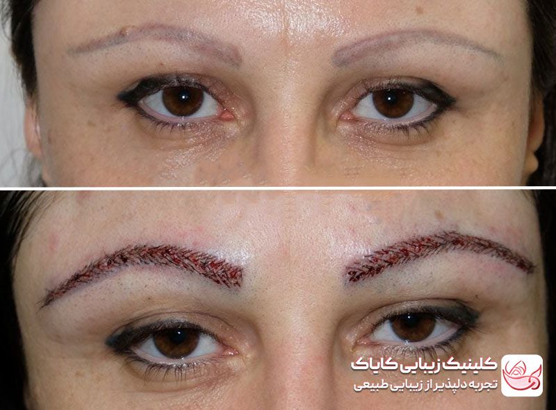 کاشت ابرو برای ریزش ابروقبل و بعد