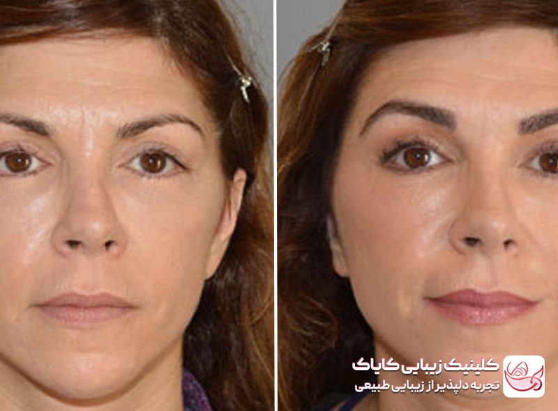 کاشت ابرو برای ریزش ابروقبل و بعد