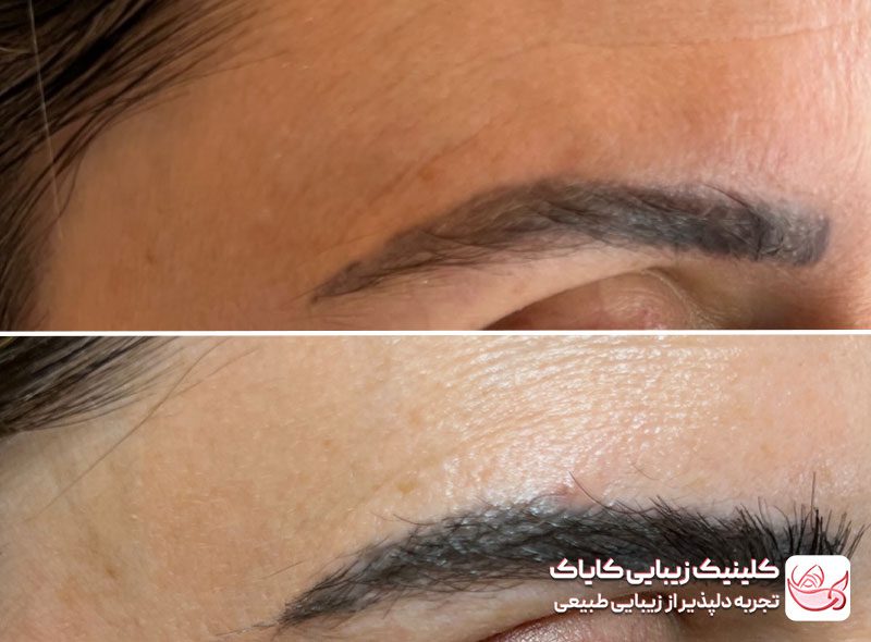 کاشت ابرو در پاسداران