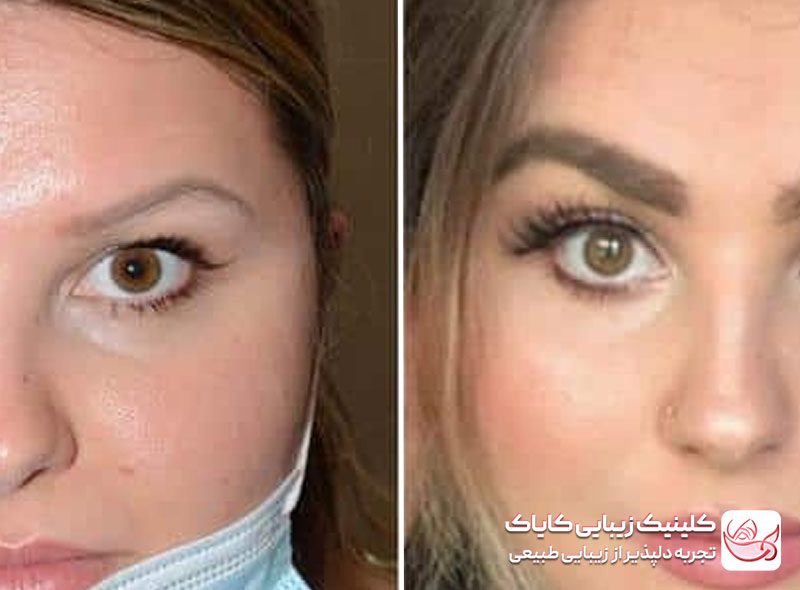 کاشت ابرو در پاسداران