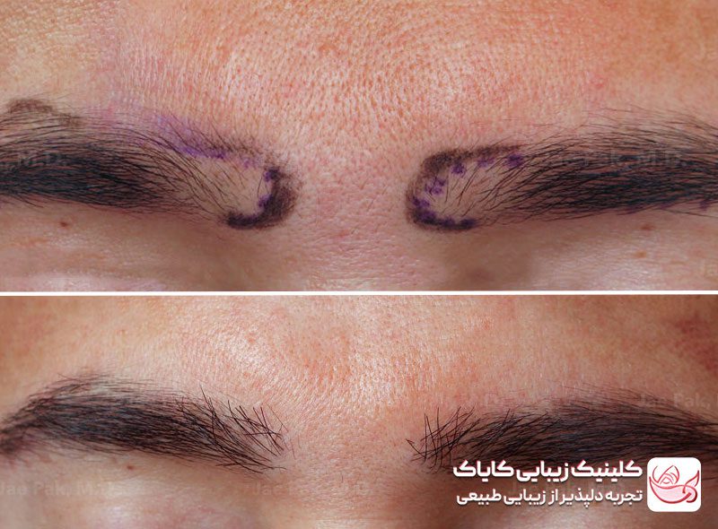 کاشت ابرو در پاسداران