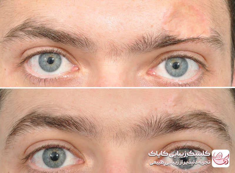 کاشت ابرو دائمی