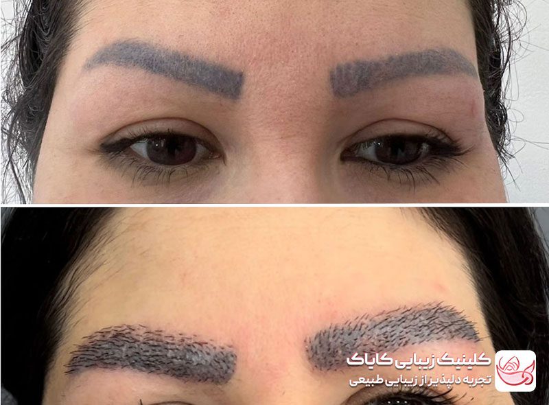 کاشت ابرو دائمی