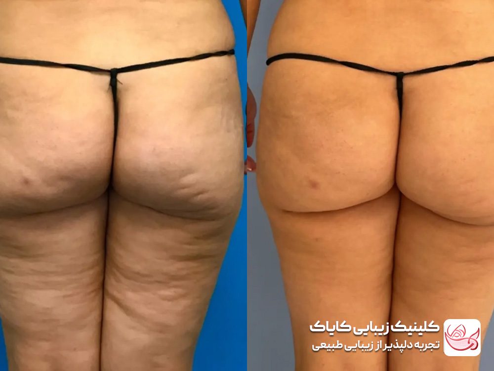 Cellulite and local fat treatment