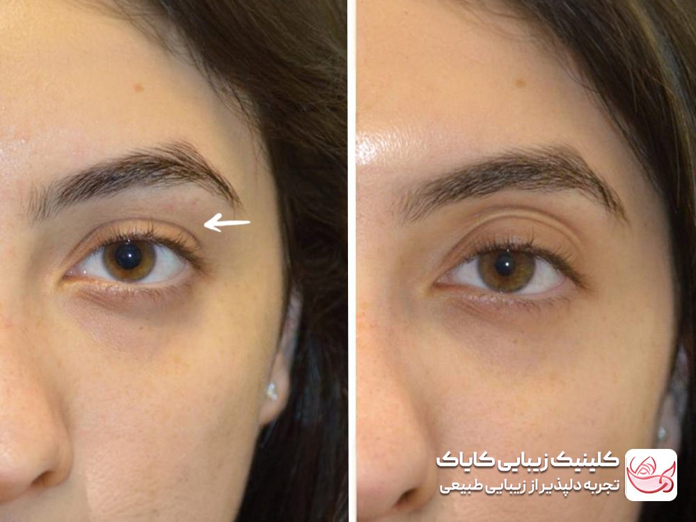 Treatment of drooping eyelids