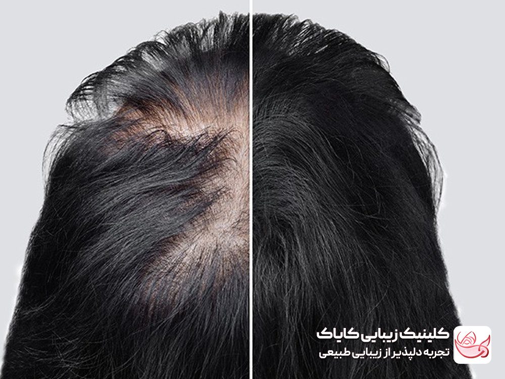 Treatment of severe hair loss