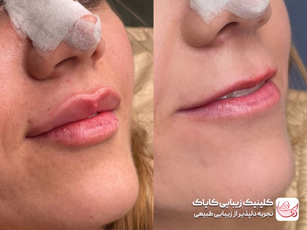 Improving the volume of thin lips