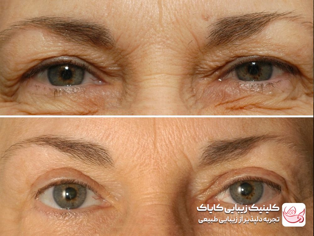 Treatment of eyelid wrinkles