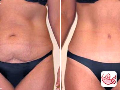 Abdomen and side mesotherapy