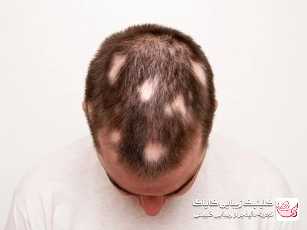 Treatment of hair loss<br>
