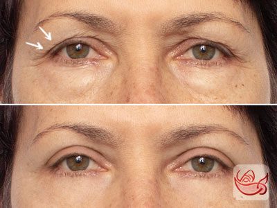 Blepharoplasty