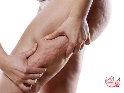 Cellulite mesotherapy