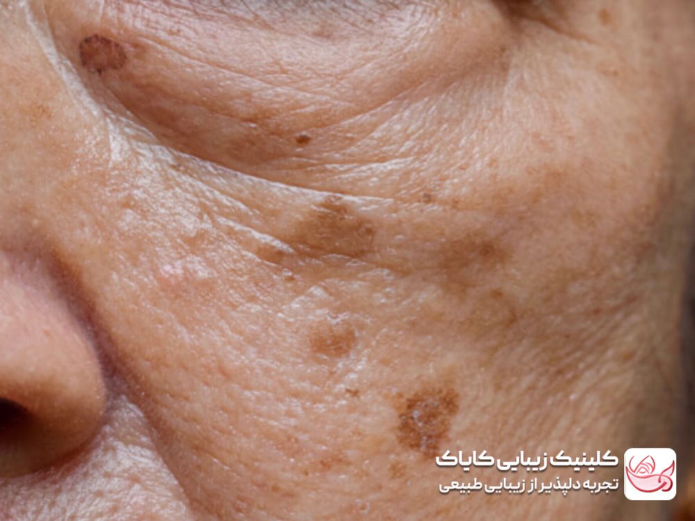 Treatment of dark skin spots