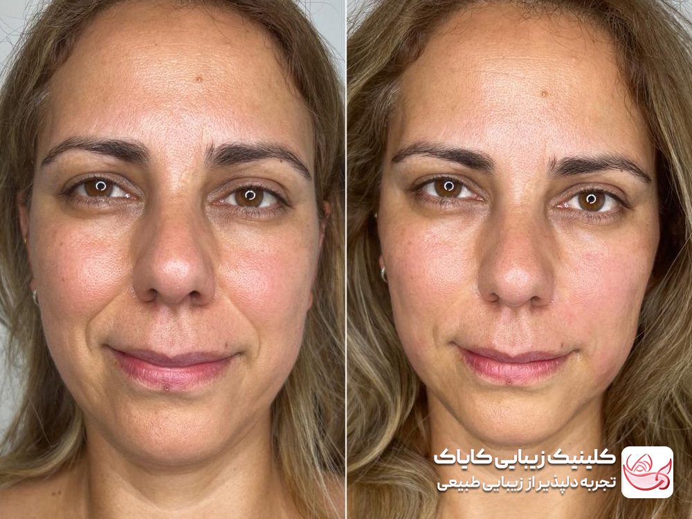 Treatment of sunken cheeks and small volume