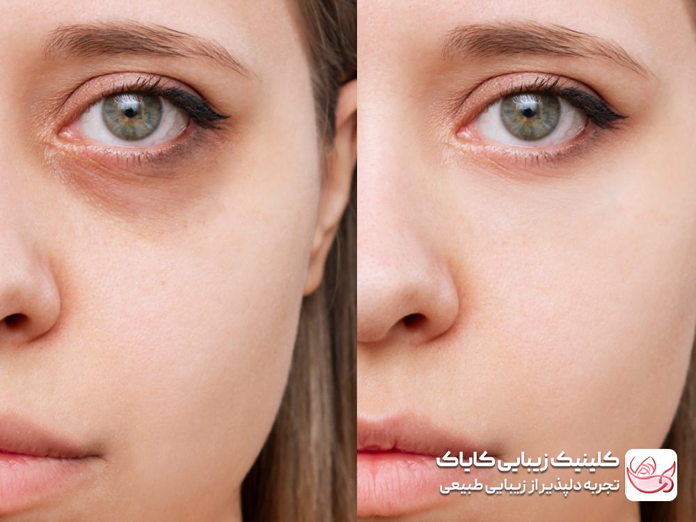 Treatment of dimples and darkness under the eyes