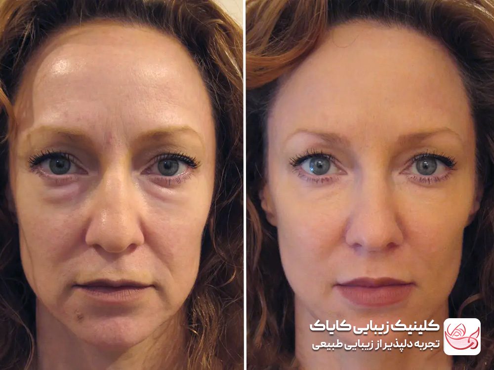 Treatment of sagging facial skin