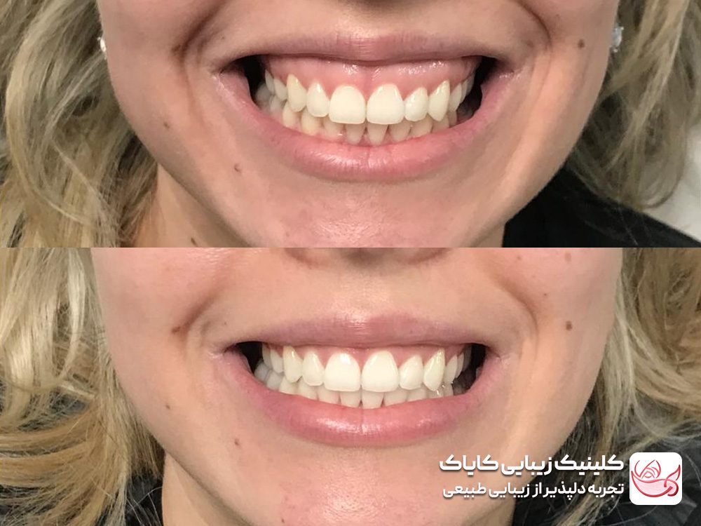 Gum smile treatment