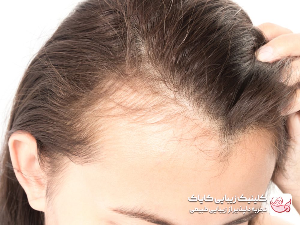 Treatment of hair loss around the head<br>
