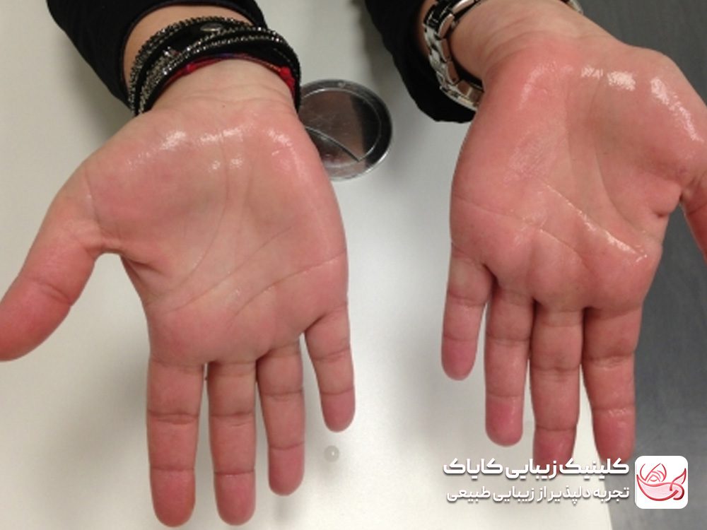 Treatment of excessive sweating of hands