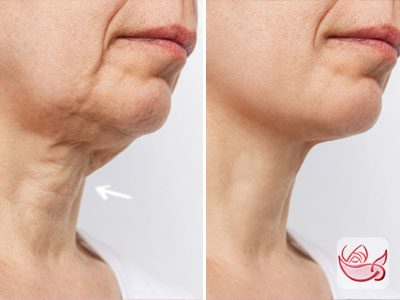 neck lift