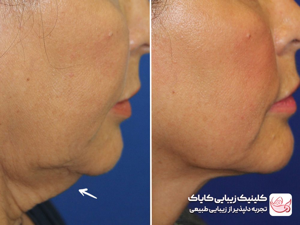 Treatment of sagging neck skin