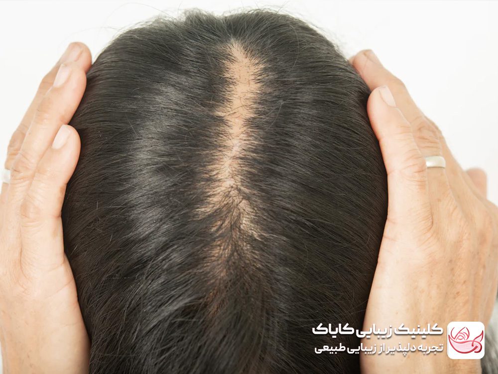 Treatment of receding hairline