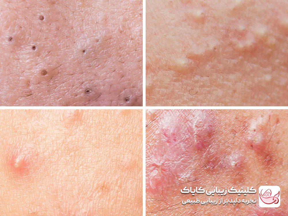 Treatment of pimples and acne