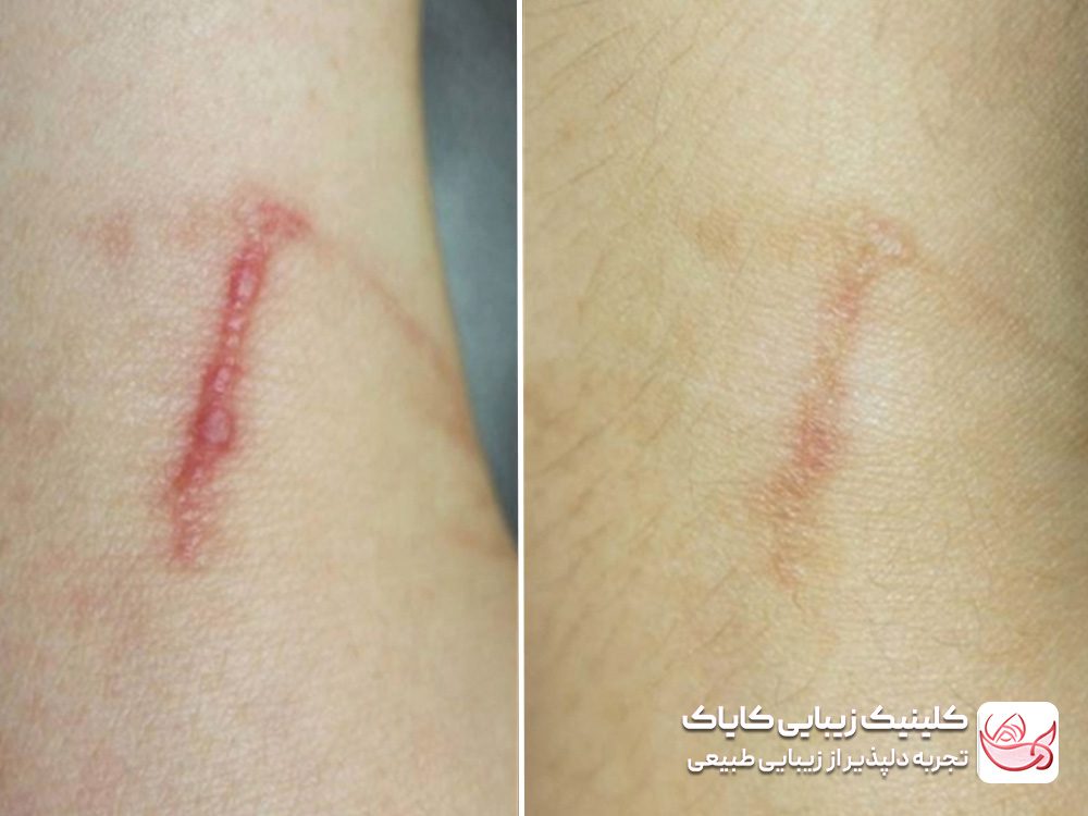 Treatment of scars and scars