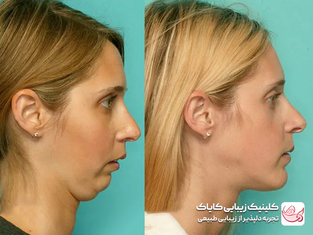 Treatment of jaw without angle