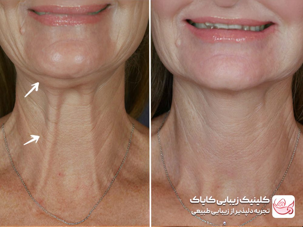 Neck skin wrinkle treatment