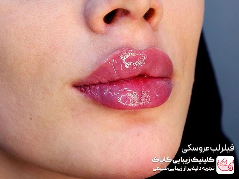 فیلر لب عروسکی