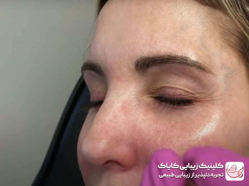 مراحل تزریق فیلر زیر چشم