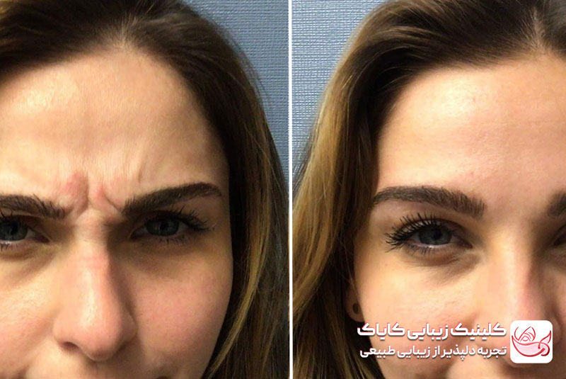 تزریق بوتاکس قبل و بعد