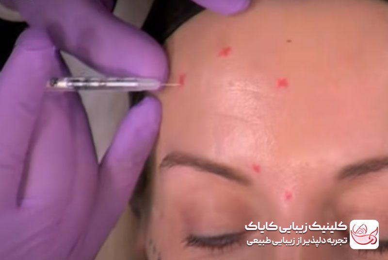 تزریق بوتاکس قبل و بعد