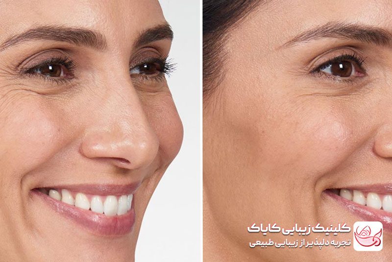 تزریق بوتاکس قبل و بعد