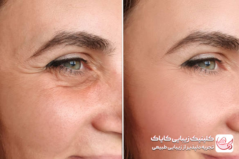 تزریق بوتاکس قبل و بعد