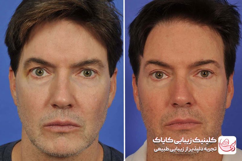 تزریق بوتاکس قبل و بعد