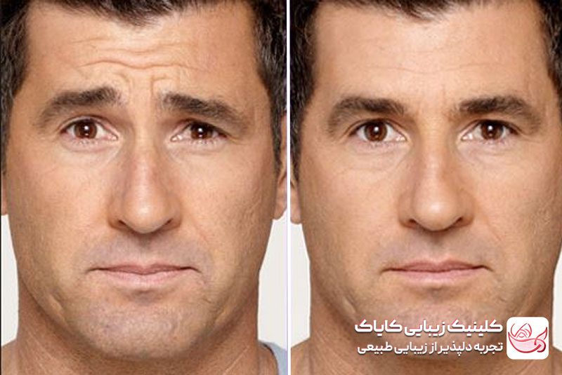 تزریق بوتاکس قبل و بعد