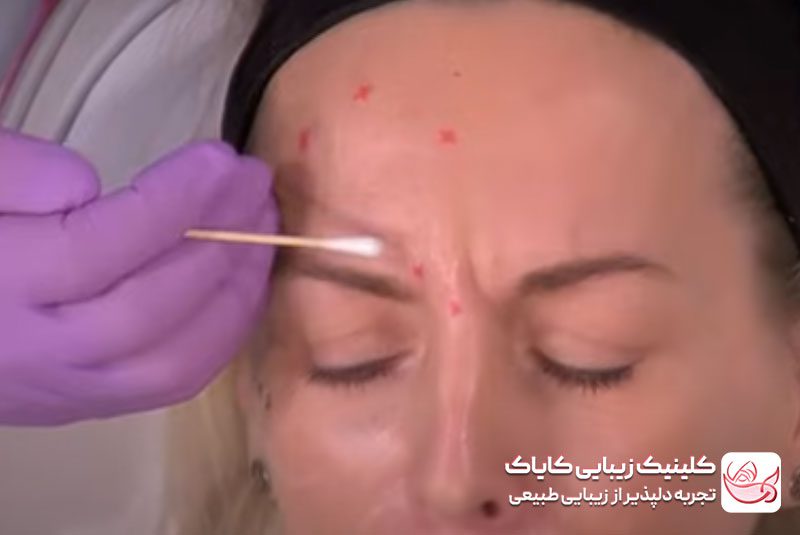 تزریق بوتاکس قبل و بعد