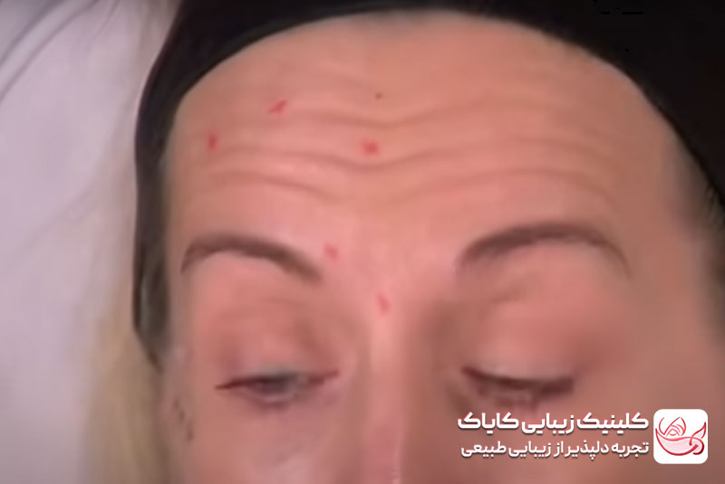 تزریق بوتاکس قبل و بعد