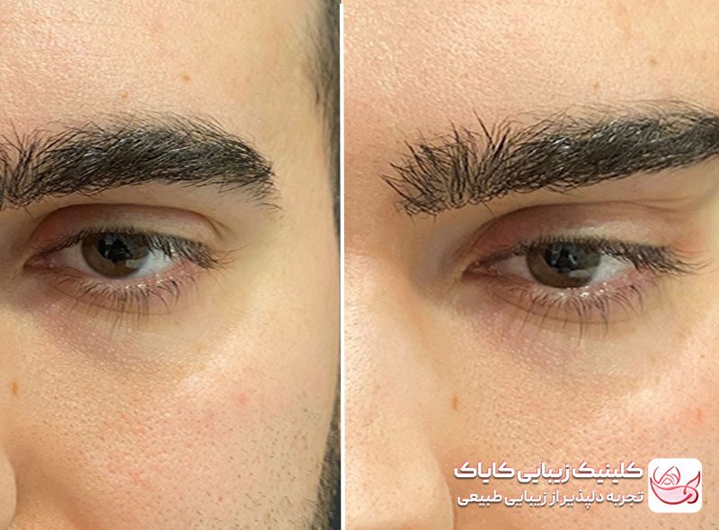 بوتاکس چشم گربه‌ ای قبل و بعد