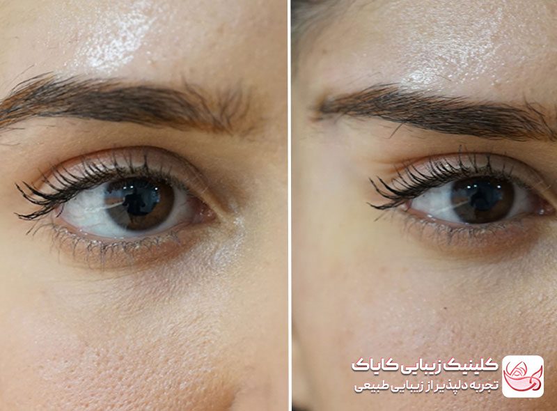 بوتاکس چشم گربه‌ ای قبل و بعد