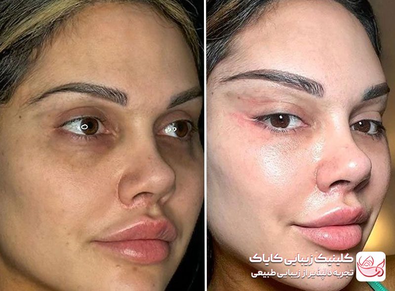 بوتاکس چشم گربه‌ ای قبل و بعد