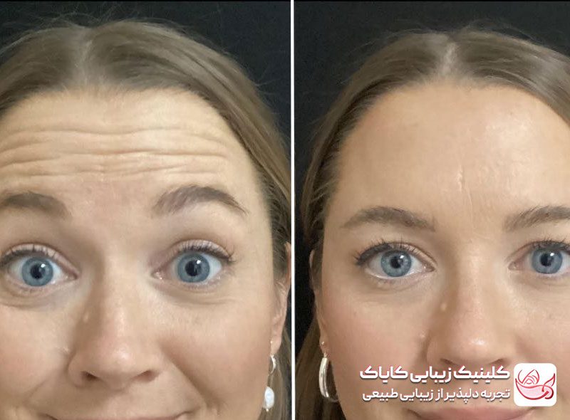 تزریق بوتاکس پیشانی