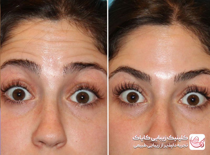 تزریق بوتاکس پیشانی